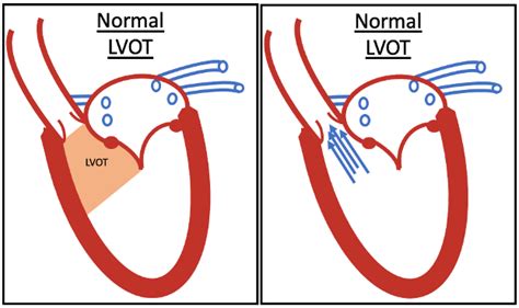 lv outflow obstruction|left ventricular outlet obstruction.